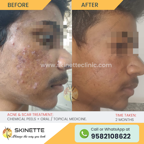 acne-scar-treatment-before-after-results-14