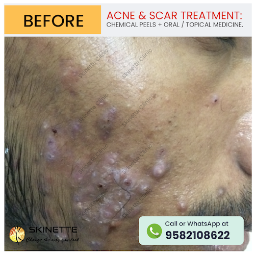 acne-scar-treatment-before-after-results-24