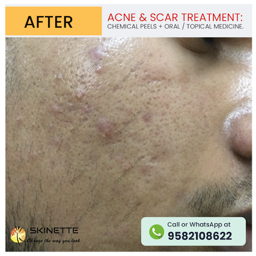 acne-scar-treatment-before-after-results-30
