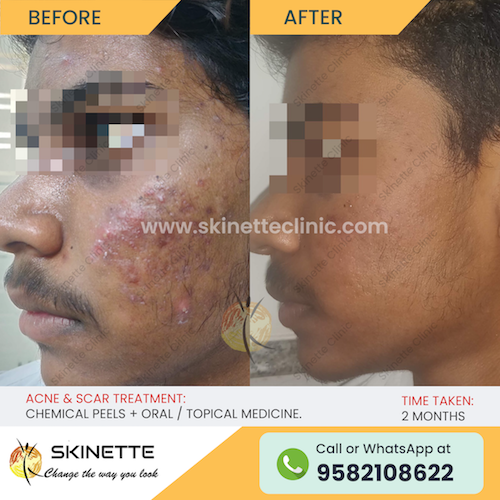 acne-scar-treatment-before-after-results-17