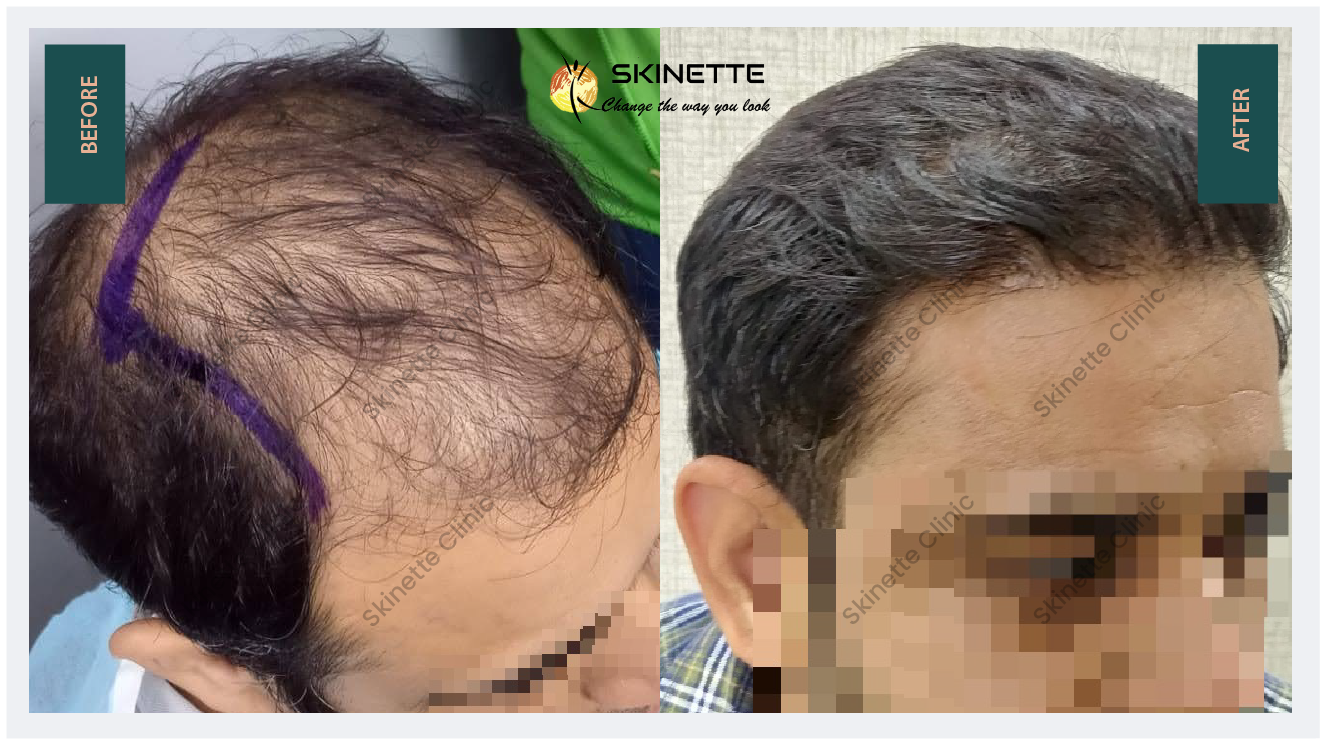 Best Hair Transplant Clinic in Faridabad and Delhi NCR - Skinette