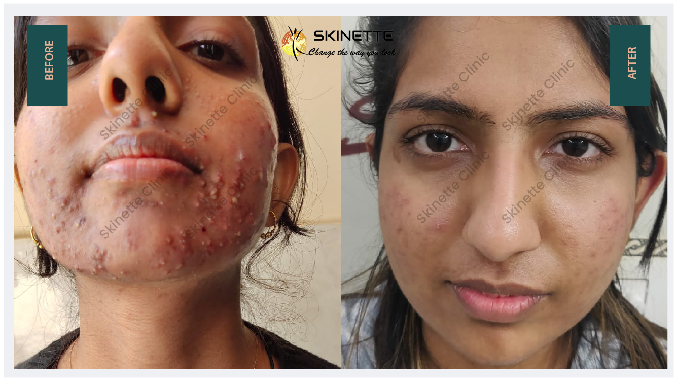 acne scar treatment before after results in skinette clinic faridabad 22