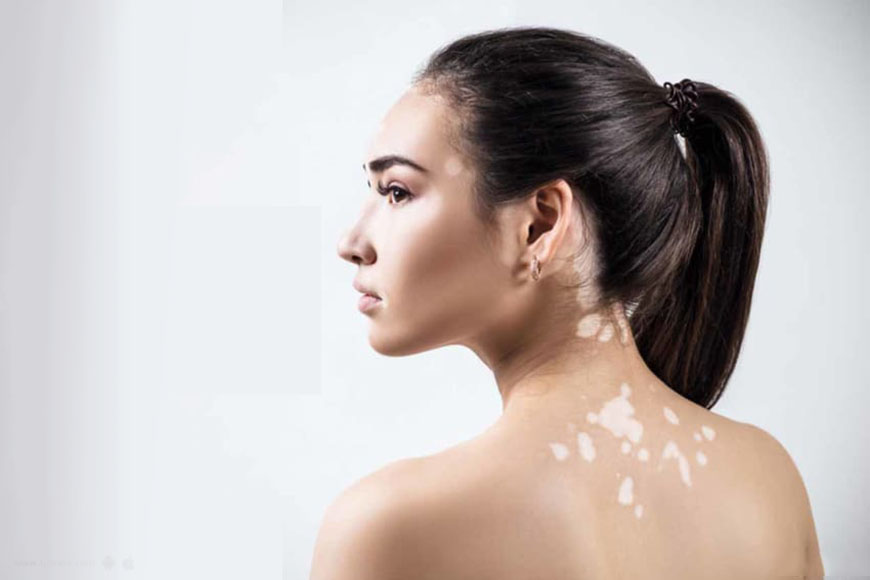 Vitiligo