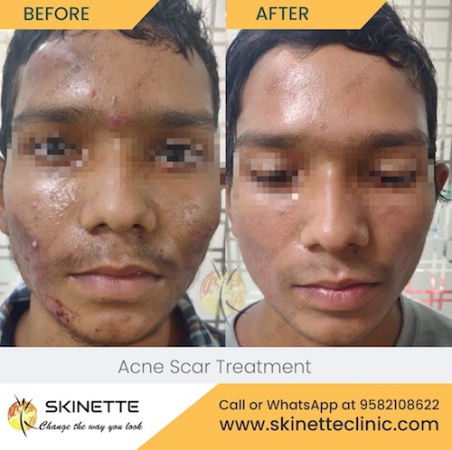 acne-scar-treatment-before-after-results-11